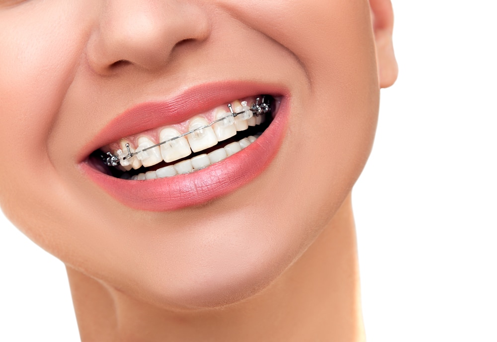 How Do You Correct an Overbite? - Central Texas Orthodontics