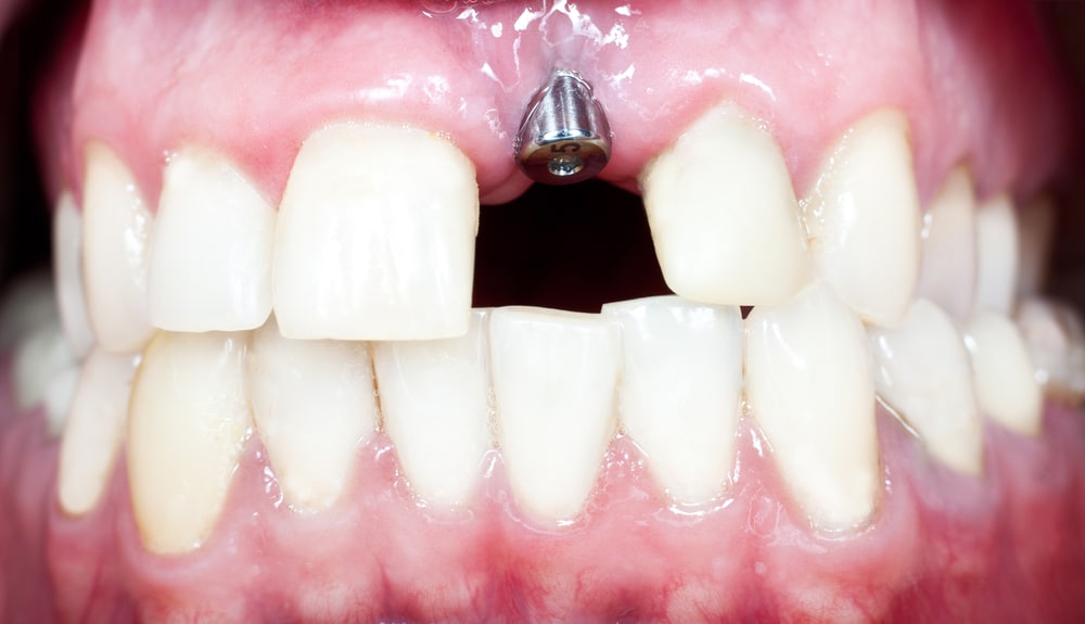 A macro shot of dental implant