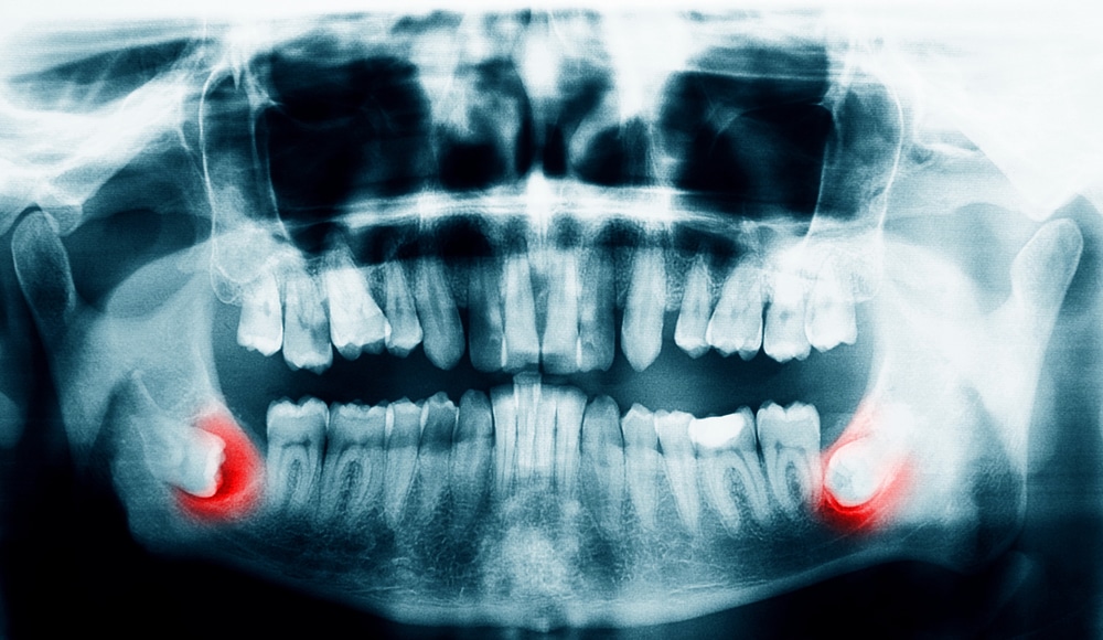 Xray scan of the teeth