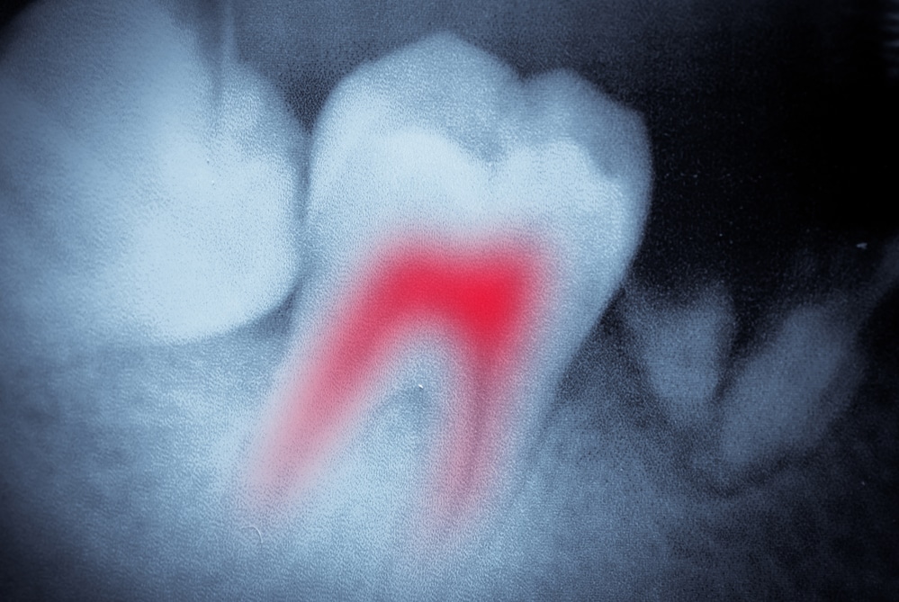 Dental film of tooth