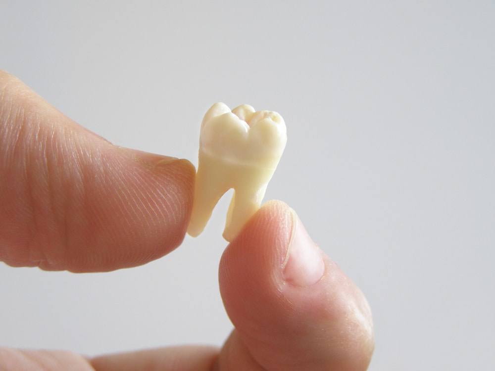 Image of Extracted Tooth