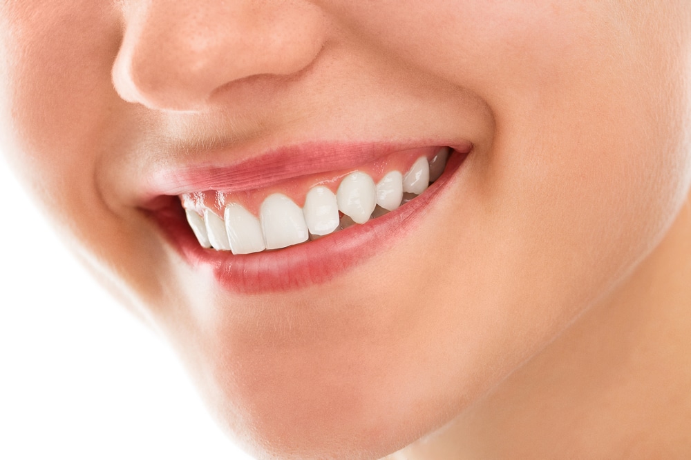 Photo of Smile After Laser Dentistry